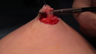 Inverted Nipple Correction