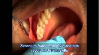Affordable Dentures Tamilnadu | Best Oral Surgeon in India