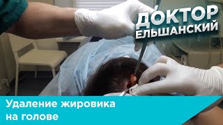 Удаление жировика на голове