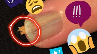 Huge! Splinter under a microscope (removal) Gross! Subscriber special!