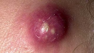 Выдавливание огромного прыща/Squeezing big pimple