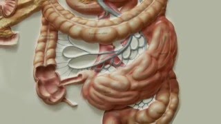 Лечение рака толстой кишки в Израиле