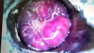 Worms | Anal Worms | Pin Worms | Worms in Anus | Pinworms