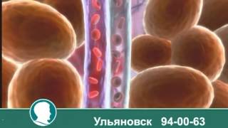 LPG массаж. Ульяновск Доктор Борменталь