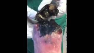 Partial Foot Amputation
