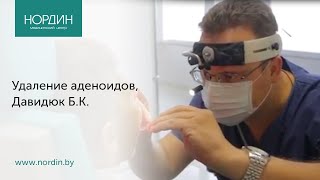 Удаление аденоидов в Минске,  Давидюк Б.К., Нордин