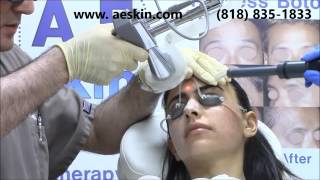 Micro Laser Peel Demonstration 1 - A E Skin - Encino, CA - 818-835-1833