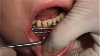 Перелом нижней челюсти - лечение