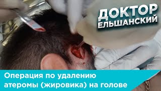 Операция по удалению атеромы (жировика) на голове