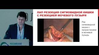 Лапароскопические операции при колоректальном раке