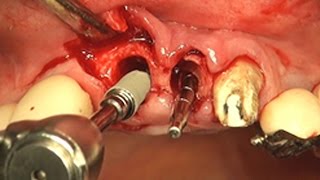 GBR on anterior esthetic zone