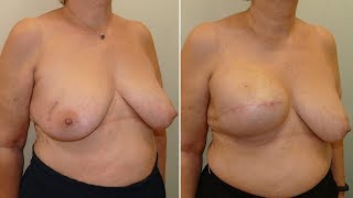 Mammary reconstruction using tissue expander and partial detachment of the pectoralis major muscle