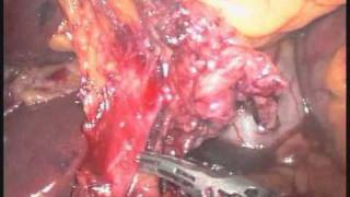 Laparoscopic Extended Subtotal Gastrectomy with LHA prevention and LND D2+