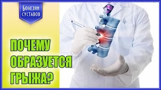 Почему образуется межпозвоночная грыжа?