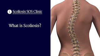 What is Scoliosis?