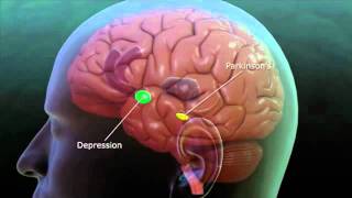 Deep Brain Stimulation explanation