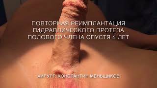 Реимплантация протеза полового члена Coloplast Titan Touch