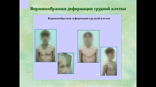 Деформация грудной клетки у детей. Воронкообразная грудная клетка. Остеопатическое лечение.