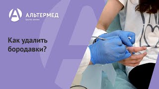 Как удалить бородавки?