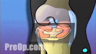 Arthroscopic Meniscus Repair of Knee Surgery PreOp® Patient Education