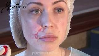 Коррекция носогубной складки препаратом PRINCESS FILLER (CROMA, Австрия)