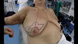 Batwing Oncoplasty & Axillary Lymphadenectomy by Single Port