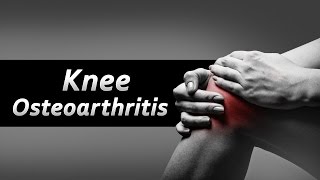 How to take care of Knee Osteoarthritis