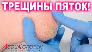 Классический педикюр. Трещины пятки. Как вылечить. Автор Елена Дзык