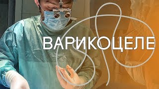 Варикоцеле. Варикозное расширение яичка вены. Метод "МАРМАРА"