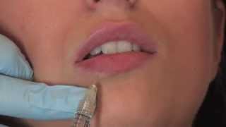 Lippenunterspritzung mit Juvederm Volbella | PULLMANN