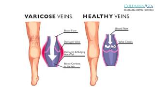 Can varicose veins lead to amputation? And when are surgeries indicated?