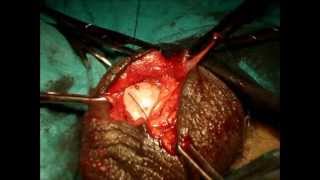 Torsion Testis surgical technique