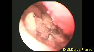 NASAL CHOLESTEATOMA