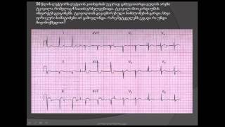 მიოკარდიუმის ქვედა კედლის მწვავე ინფარქტი (როგორ წავიკითხოთ ეკგ) / III და AVF ეკგ განხრები