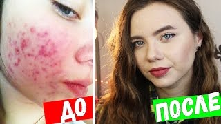 КАК БЫСТРО ИЗБАВИТЬСЯ ОТ ПРЫЩЕЙ