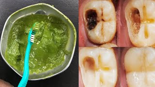 एक बार में ही दांत का कीड़ा और दर्द बाहर निकालने का सरल उपाय|dant dard ka ilaj|Teeth pain