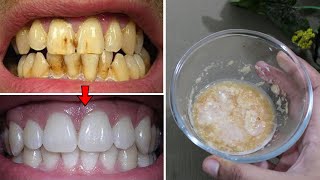 RESEP DARI NENEK! GIGI KUNING ATAU PLAK GIGI LANGSUNG LUNTUR DENGAN RACIKAN INI 