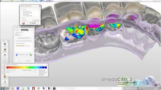simedaCAD (exoCAD) Articulator