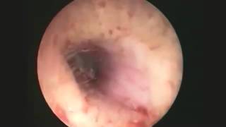 Chuyện Lạ Có Thật Trên Thế Giới – Kinh Dị Dòi Làm Tổ Trong Tai  ► P.20
