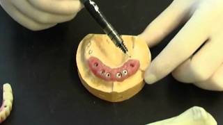 Prothèse fixe transvissée sur implant
