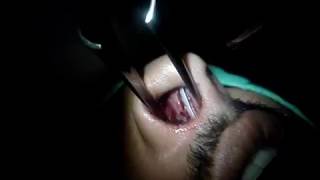 Dr. Arfat's technique of septoplasty without nasal packing