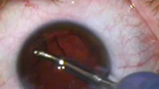 Modern Cataract Surgery with Toric IOL