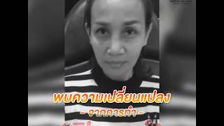 ฟิลเลอร์ใต้ตา  ฟิลเลอร์ยกกระชับ 【By DoctorMekClinic.com】