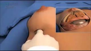 Prótese de Silicone Explicada - Mamoplastia RJ