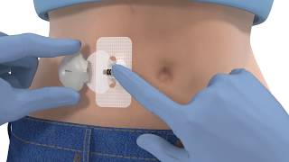 iPro2 Professional Continuous Glucose Monitoring System