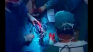 male to female surgery video