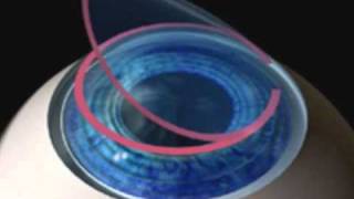 LASIK - Laser Eye Surgery - Advances and Benefits by Dr. Cory Lessner