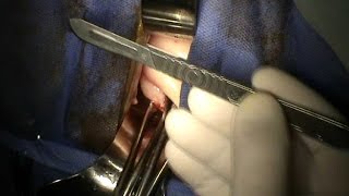 Total Vaginal Hysterectomy. Uterine fibroids. Uterine morcellation