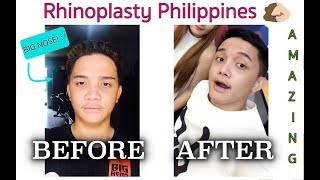 RHINOPLASTY BEFORE AND AFTER (9 months after the surgery)