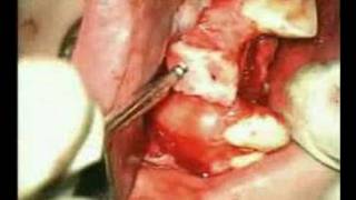 Auto transplantation / Аутотрансплантация